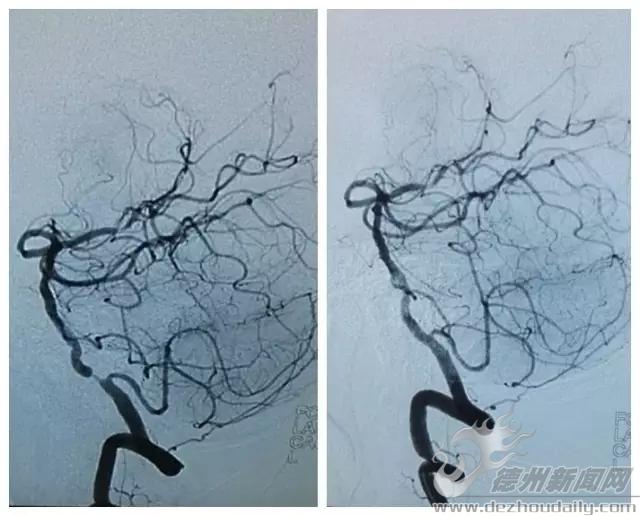 德州联合医院成功实施首例脑血管介入支架成形术